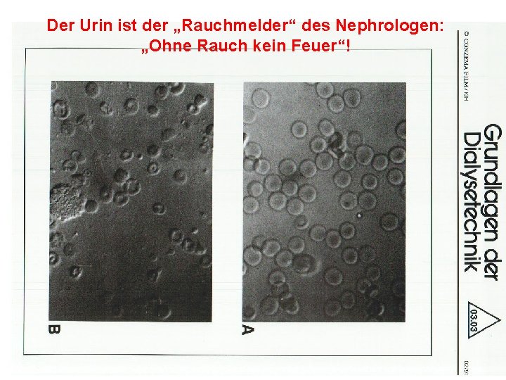 Der Urin ist der „Rauchmelder“ des Nephrologen: „Ohne Rauch kein Feuer“! 