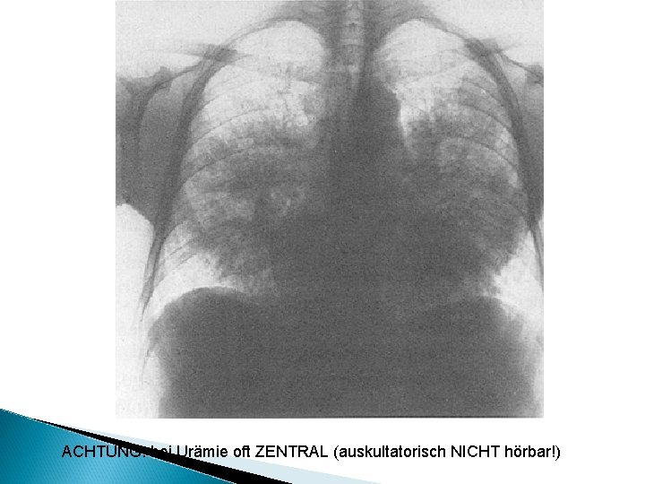 ACHTUNG: bei Urämie oft ZENTRAL (auskultatorisch NICHT hörbar!) 