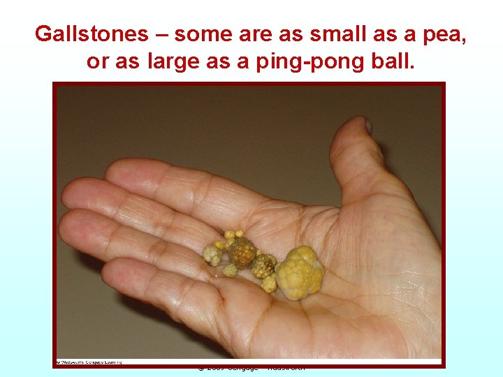 Gallstones – some are as small as a pea, or as large as a