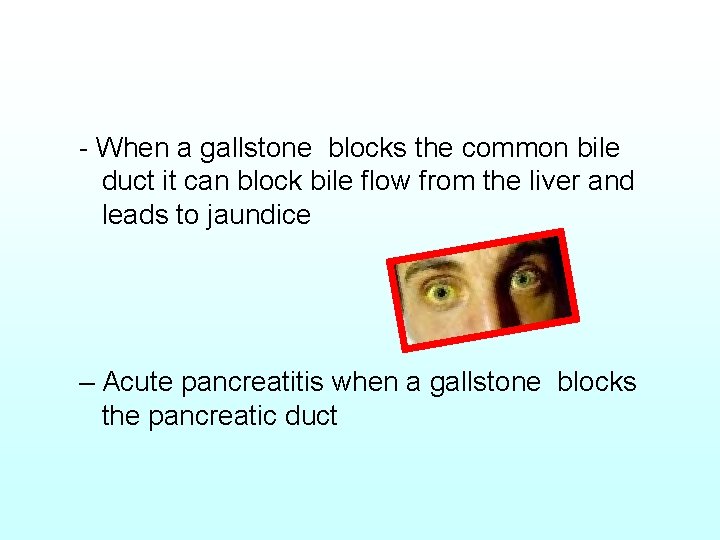 - When a gallstone blocks the common bile duct it can block bile flow