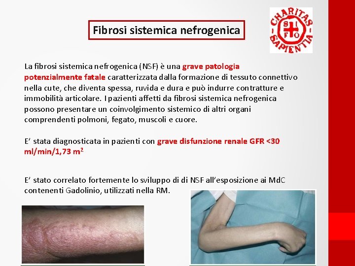 Fibrosi sistemica nefrogenica La fibrosi sistemica nefrogenica (NSF) è una grave patologia potenzialmente fatale