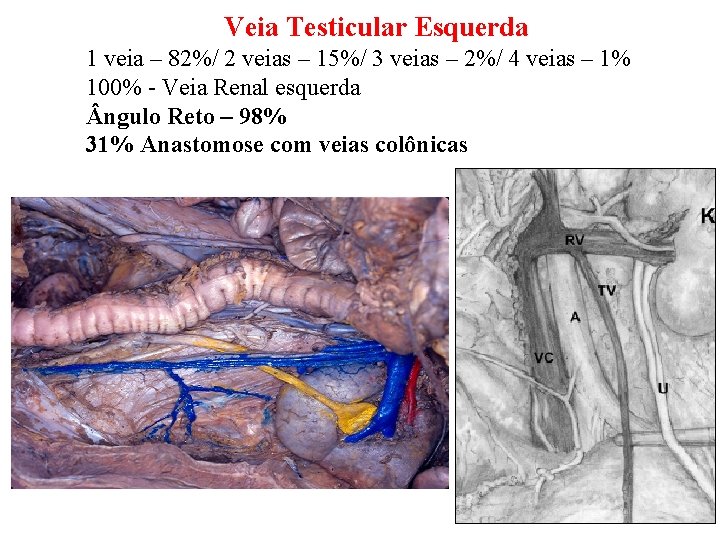 Veia Testicular Esquerda 1 veia – 82%/ 2 veias – 15%/ 3 veias – Veia Testicular Esquerda 1 veia – 82%/ 2 veias – 15%/ 3 veias –