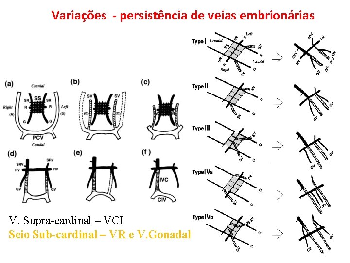 Variações - persistência de veias embrionárias V. Supra-cardinal – VCI Seio Sub-cardinal – VR Variações - persistência de veias embrionárias V. Supra-cardinal – VCI Seio Sub-cardinal – VR