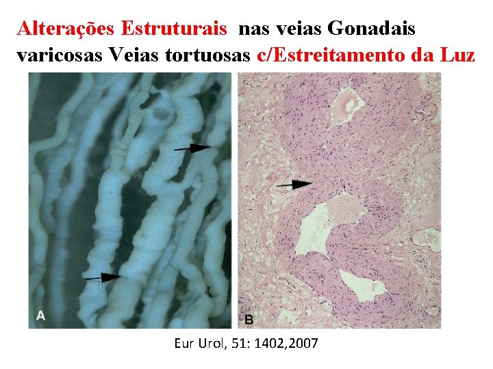 Alterações Estruturais nas veias Gonadais varicosas Veias tortuosas c/Estreitamento da Luz Eur Urol, 51: Alterações Estruturais nas veias Gonadais varicosas Veias tortuosas c/Estreitamento da Luz Eur Urol, 51: