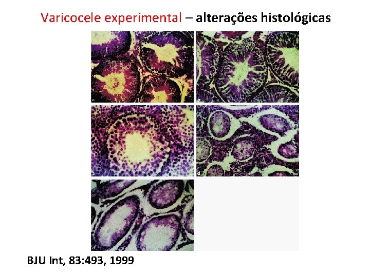 Varicocele experimental – alterações histológicas BJU Int, 83: 493, 1999 Varicocele experimental – alterações histológicas BJU Int, 83: 493, 1999