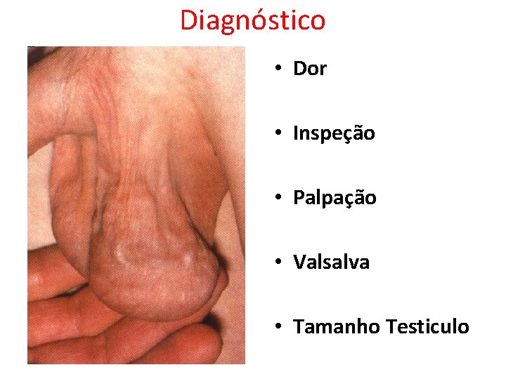 Diagnóstico • Dor • Inspeção • Palpação • Valsalva • Tamanho Testiculo Diagnóstico • Dor • Inspeção • Palpação • Valsalva • Tamanho Testiculo