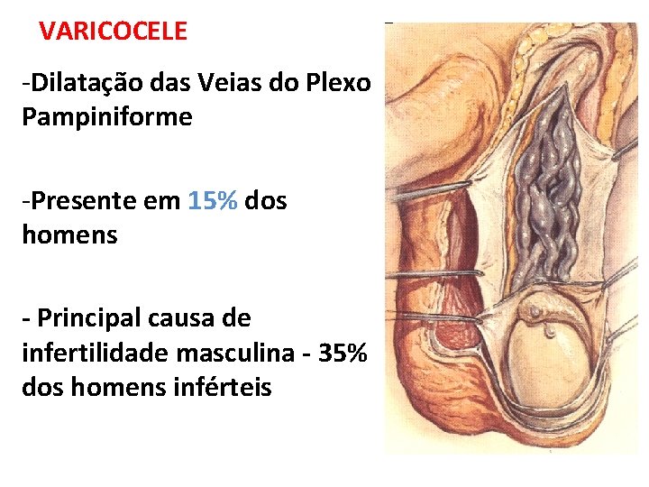 VARICOCELE -Dilatação das Veias do Plexo Pampiniforme -Presente em 15% dos homens - Principal VARICOCELE -Dilatação das Veias do Plexo Pampiniforme -Presente em 15% dos homens - Principal