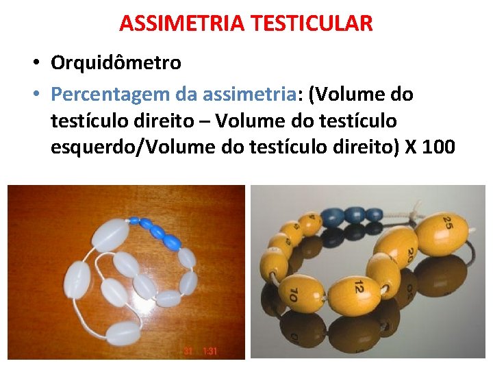 ASSIMETRIA TESTICULAR • Orquidômetro • Percentagem da assimetria: (Volume do testículo direito – Volume ASSIMETRIA TESTICULAR • Orquidômetro • Percentagem da assimetria: (Volume do testículo direito – Volume