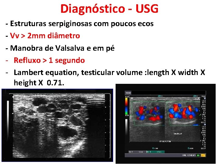 Diagnóstico - USG - Estruturas serpiginosas com poucos ecos - Vv > 2 mm Diagnóstico - USG - Estruturas serpiginosas com poucos ecos - Vv > 2 mm