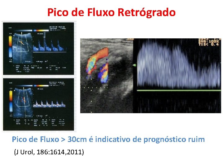 Pico de Fluxo Retrógrado Pico de Fluxo > 30 cm é indicativo de prognóstico Pico de Fluxo Retrógrado Pico de Fluxo > 30 cm é indicativo de prognóstico