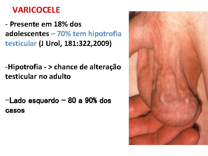 VARICOCELE - Presente em 18% dos adolescentes – 70% tem hipotrofia testicular (J Urol, VARICOCELE - Presente em 18% dos adolescentes – 70% tem hipotrofia testicular (J Urol,