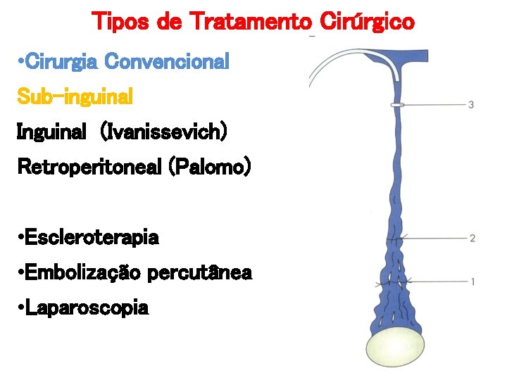 Tipos de Tratamento Cirúrgico • Cirurgia Convencional Sub-inguinal Inguinal (Ivanissevich) Retroperitoneal (Palomo) • Escleroterapia Tipos de Tratamento Cirúrgico • Cirurgia Convencional Sub-inguinal Inguinal (Ivanissevich) Retroperitoneal (Palomo) • Escleroterapia