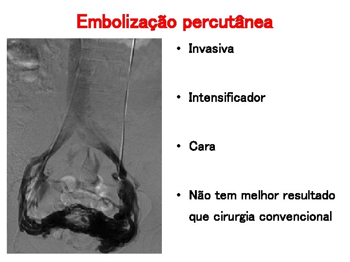 Embolização percutânea • Invasiva • Intensificador • Cara • Não tem melhor resultado que Embolização percutânea • Invasiva • Intensificador • Cara • Não tem melhor resultado que