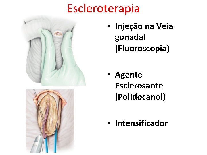Escleroterapia • Injeção na Veia gonadal (Fluoroscopia) • Agente Esclerosante (Polidocanol) • Intensificador Escleroterapia • Injeção na Veia gonadal (Fluoroscopia) • Agente Esclerosante (Polidocanol) • Intensificador