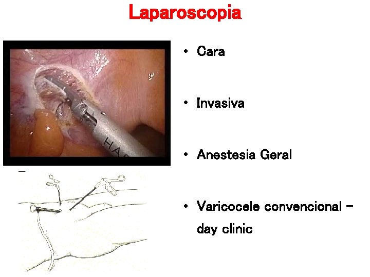 Laparoscopia • Cara • Invasiva • Anestesia Geral • Varicocele convencional – day clinic Laparoscopia • Cara • Invasiva • Anestesia Geral • Varicocele convencional – day clinic