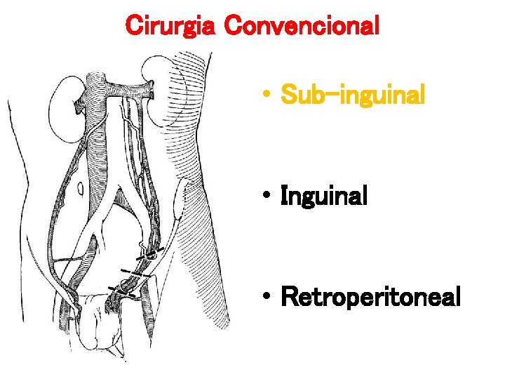 Cirurgia Convencional • Sub-inguinal • Inguinal • Retroperitoneal Cirurgia Convencional • Sub-inguinal • Inguinal • Retroperitoneal