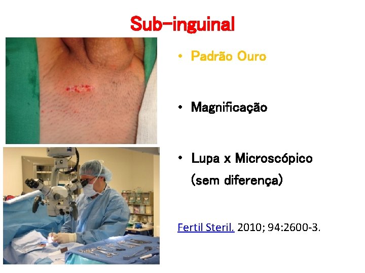 Sub-inguinal • Padrão Ouro • Magnificação • Lupa x Microscópico (sem diferença) Fertil Steril. Sub-inguinal • Padrão Ouro • Magnificação • Lupa x Microscópico (sem diferença) Fertil Steril.