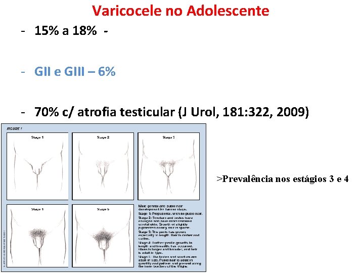 Varicocele no Adolescente - 15% a 18% - GII e GIII – 6% - Varicocele no Adolescente - 15% a 18% - GII e GIII – 6% -