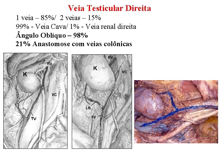 Veia Testicular Direita 1 veia – 85%/ 2 veias – 15% 99% - Veia Veia Testicular Direita 1 veia – 85%/ 2 veias – 15% 99% - Veia