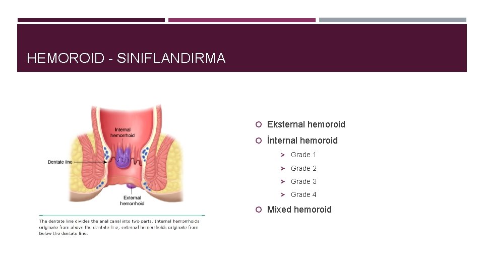 HEMOROID - SINIFLANDIRMA Eksternal hemoroid İnternal hemoroid Ø Grade 1 Ø Grade 2 Ø