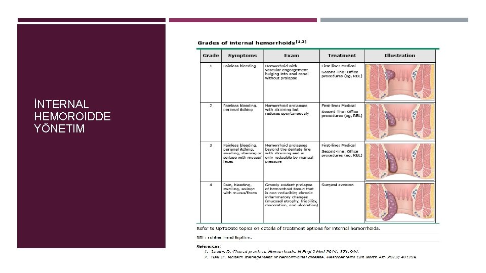 İNTERNAL HEMOROIDDE YÖNETIM 