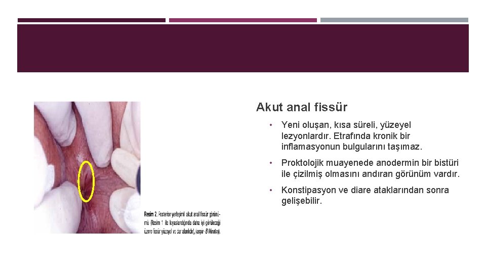 Akut anal fissür • Yeni oluşan, kısa süreli, yüzeyel lezyonlardır. Etrafında kronik bir inflamasyonun