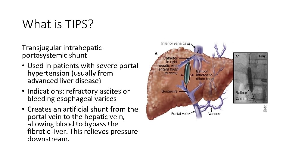 What is TIPS? Transjugular intrahepatic portosystemic shunt • Used in patients with severe portal What is TIPS? Transjugular intrahepatic portosystemic shunt • Used in patients with severe portal