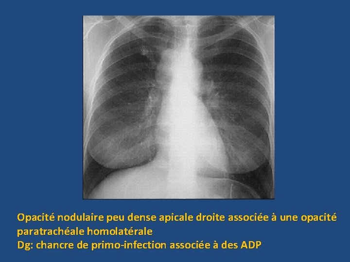 Linfection tuberculeuse Dr F KHALOUF La tuberculose maladie
