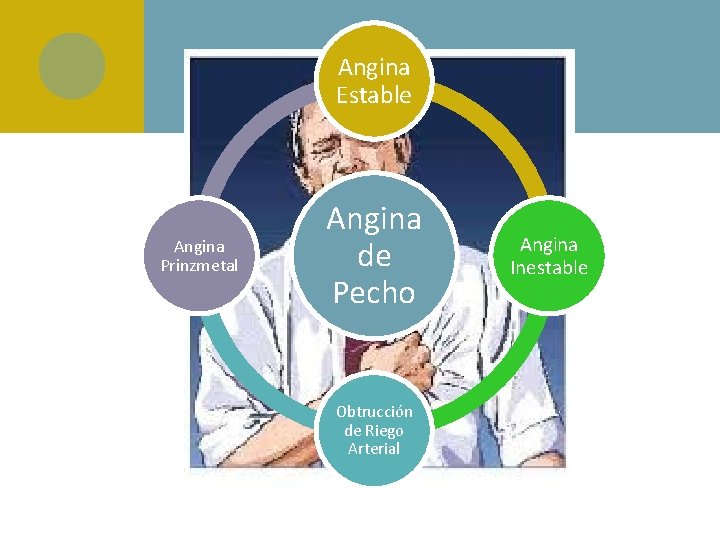 Angina Estable Angina Prinzmetal Angina de Pecho Obtrucción de Riego Arterial Angina Inestable 