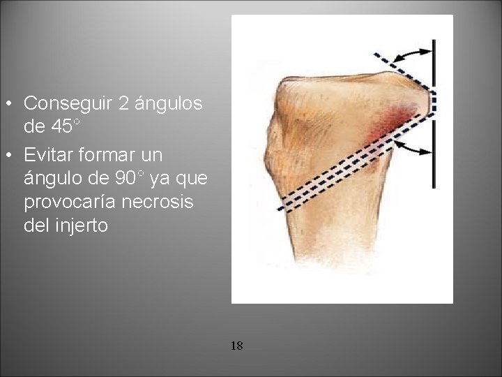  • Conseguir 2 ángulos de 45° • Evitar formar un ángulo de 90°