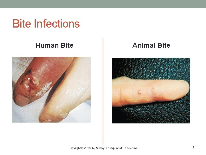 Bite Infections Human Bite Animal Bite Copyright © 2014, by Mosby, an imprint of