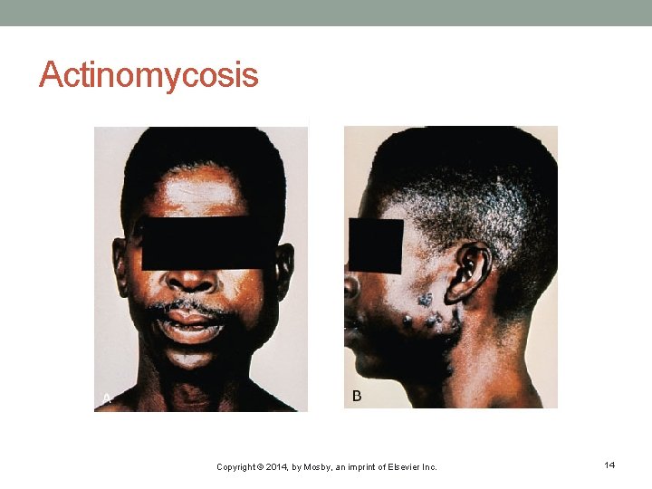 Actinomycosis Copyright © 2014, by Mosby, an imprint of Elsevier Inc. 14 