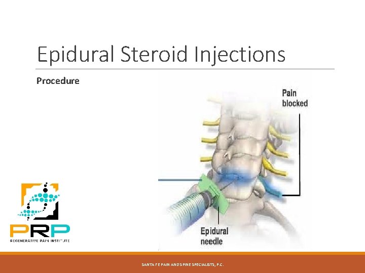 Epidural Steroid Injections Procedure SANTA FE PAIN AND SPINE SPECIALISTS, P. C. 