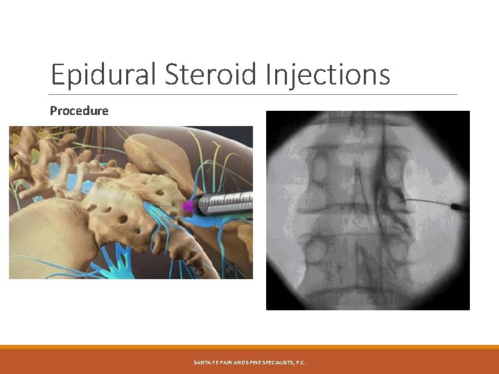 Epidural Steroid Injections Procedure SANTA FE PAIN AND SPINE SPECIALISTS, P. C. 