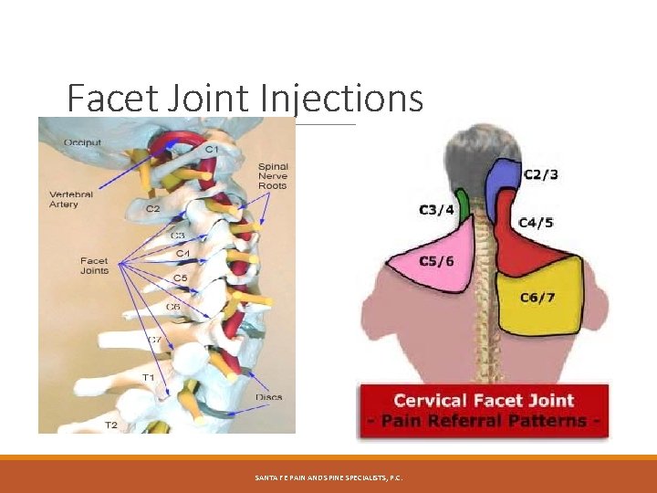 Facet Joint Injections Cervical facet referred pain SANTA FE PAIN AND SPINE SPECIALISTS, P.