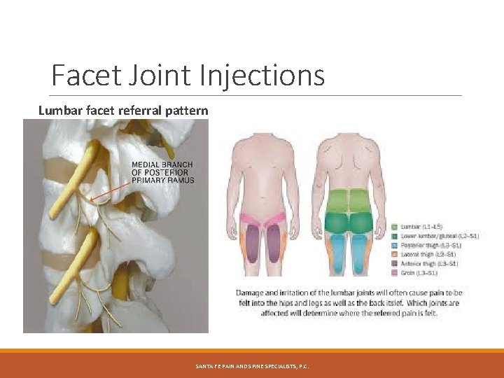 Facet Joint Injections Lumbar facet referral pattern SANTA FE PAIN AND SPINE SPECIALISTS, P.