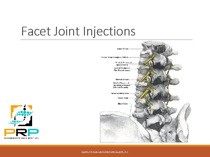 Facet Joint Injections SANTA FE PAIN AND SPINE SPECIALISTS, P. C. 