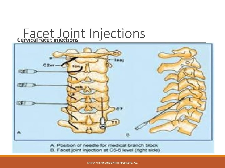 Facet Joint Injections Cervical facet injections SANTA FE PAIN AND SPINE SPECIALISTS, P. C.