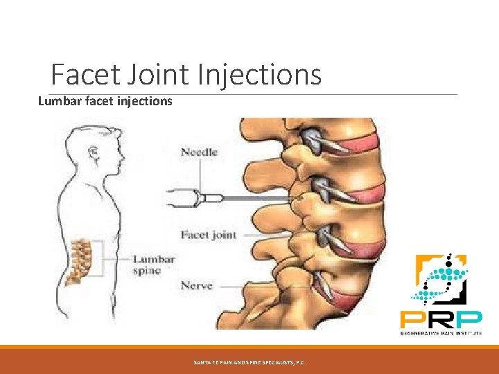 Facet Joint Injections Lumbar facet injections SANTA FE PAIN AND SPINE SPECIALISTS, P. C.