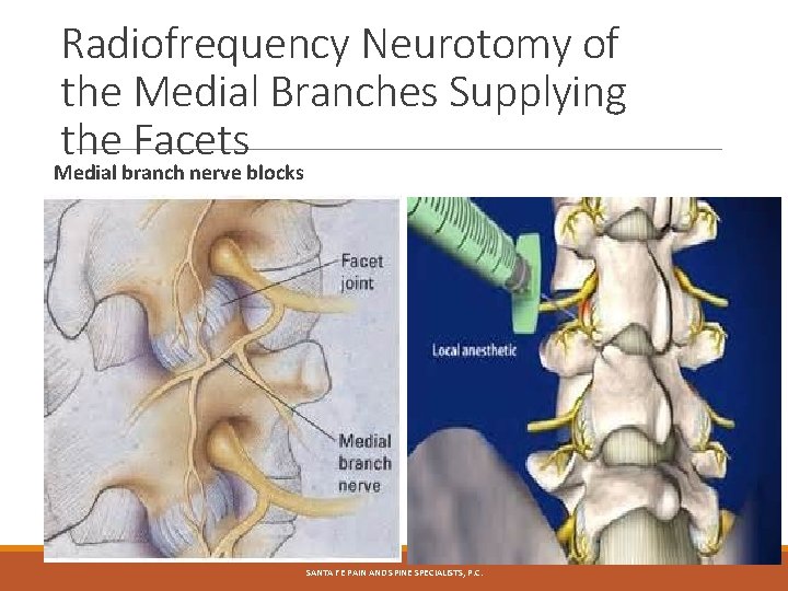 Radiofrequency Neurotomy of the Medial Branches Supplying the Facets Medial branch nerve blocks SANTA