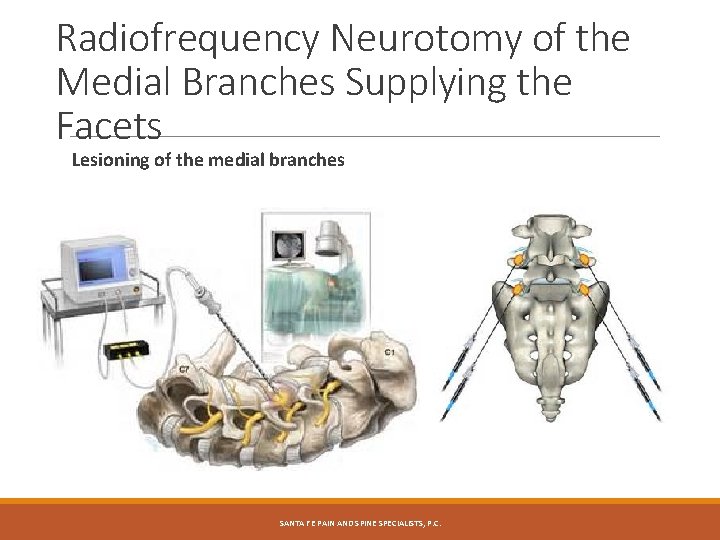 Radiofrequency Neurotomy of the Medial Branches Supplying the Facets Lesioning of the medial branches