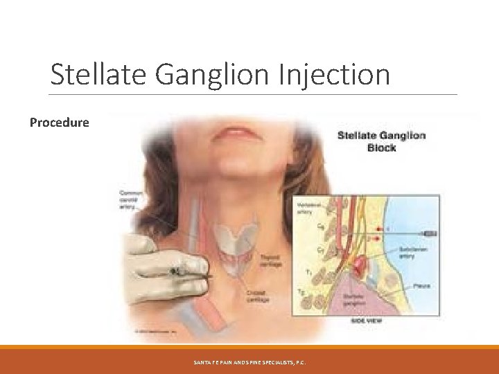 Stellate Ganglion Injection Procedure SANTA FE PAIN AND SPINE SPECIALISTS, P. C. Stellate Ganglion Injection Procedure SANTA FE PAIN AND SPINE SPECIALISTS, P. C.
