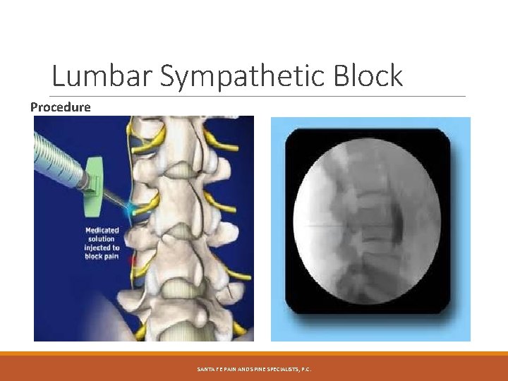Lumbar Sympathetic Block Procedure SANTA FE PAIN AND SPINE SPECIALISTS, P. C. 