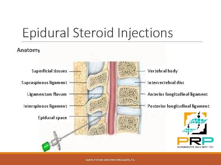 Epidural Steroid Injections Anatomy Superficial tissues Vertebral body Supraspinous ligament Intervertebral disc Ligamentum flavum