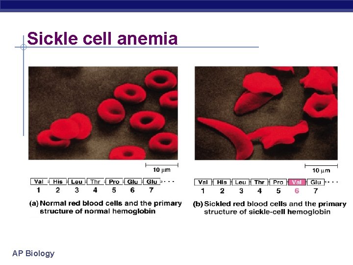 Sickle cell anemia AP Biology 