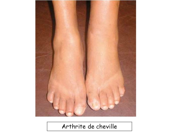 Arthrite de cheville 