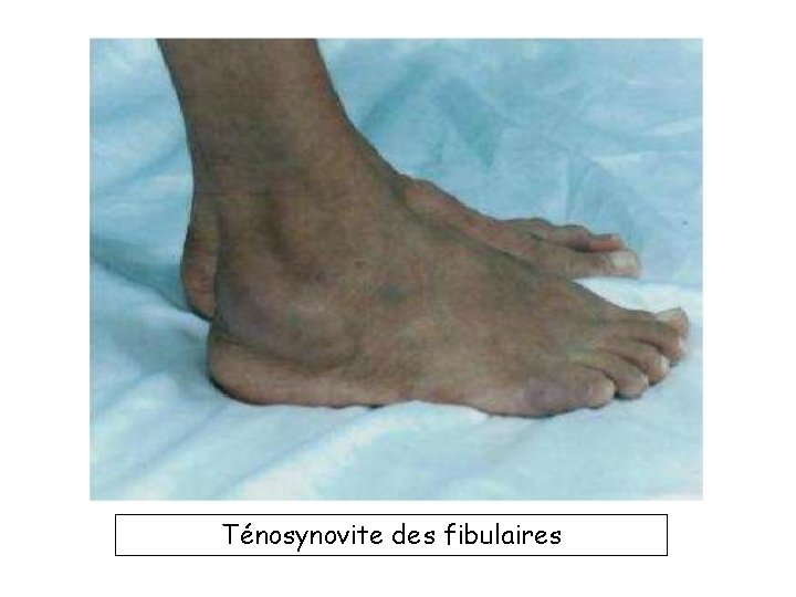 Ténosynovite des fibulaires 