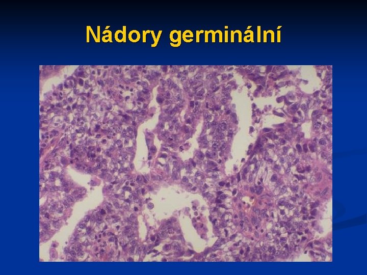 Nádory germinální 