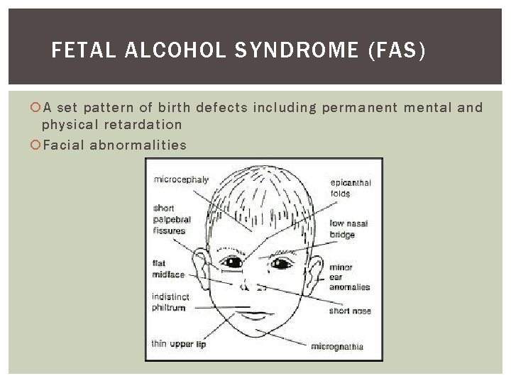 FETAL ALCOHOL SYNDROME (FAS) A set pattern of birth defects including permanent mental and