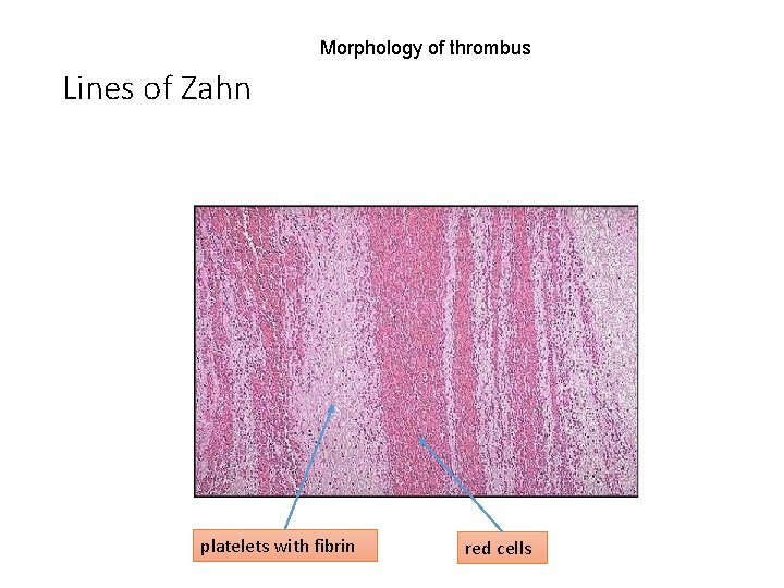 Thromboembolism Pathology Department Ksu Riyadh 2015 Objectives Understand